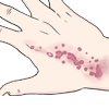 Skin Rash - Eczema